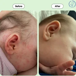 Bye-Bye Cradle Cap Bundle